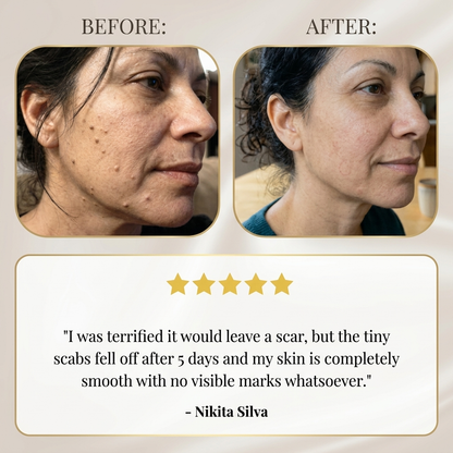 Skin Blemish Removal Pen